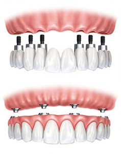 implantoprotetyka_dentystyczna2