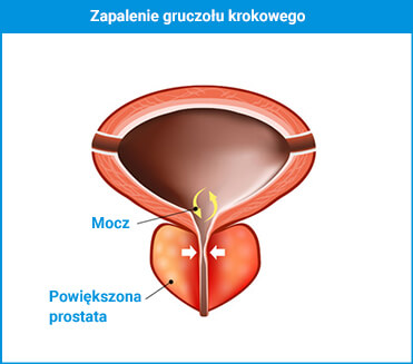 propolis krónikus prosztatitisekkel