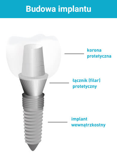 Budowa implantów zębów