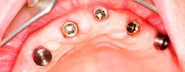 zabieg implantacji zębów