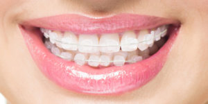 Aparat ortodontyczny kryształowy - co trzeba o nim wiedzieć?