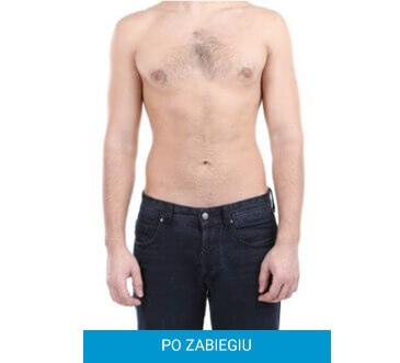 Leczenie nadwagi po zabiegu