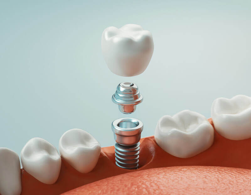 implant
