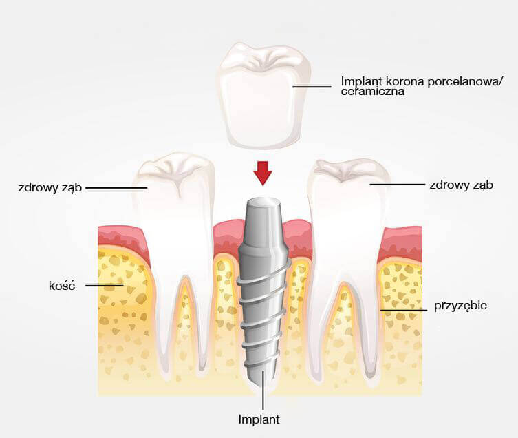 Jak działa implant