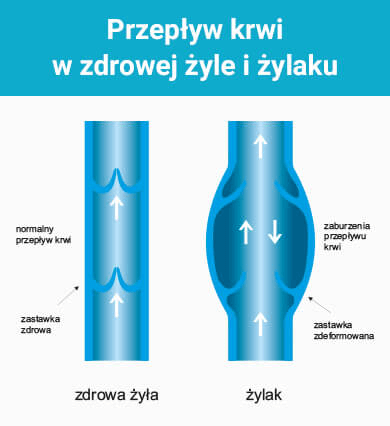 przepływ krwi w żylakach