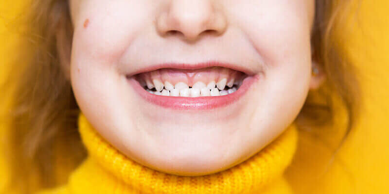 wady zgryzu u dzieci